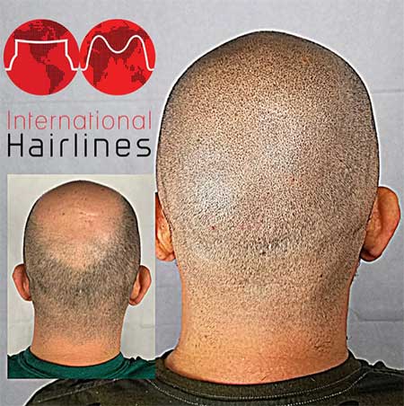 Scalp Micropigmentatio for Hair Loss